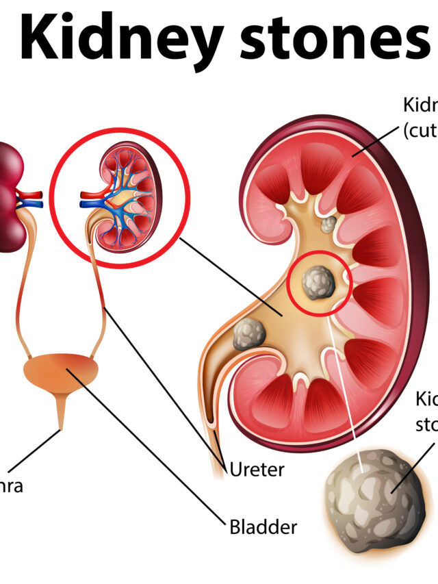 7 home remedies to fight kidney stones naturally.