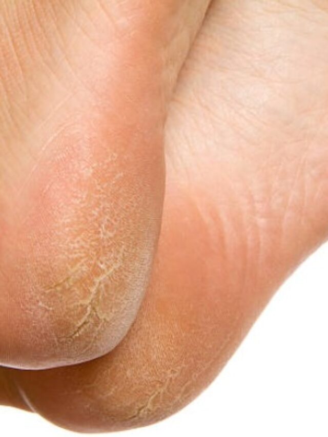 6 amazing home remedies to deal with cracked and dry heels.